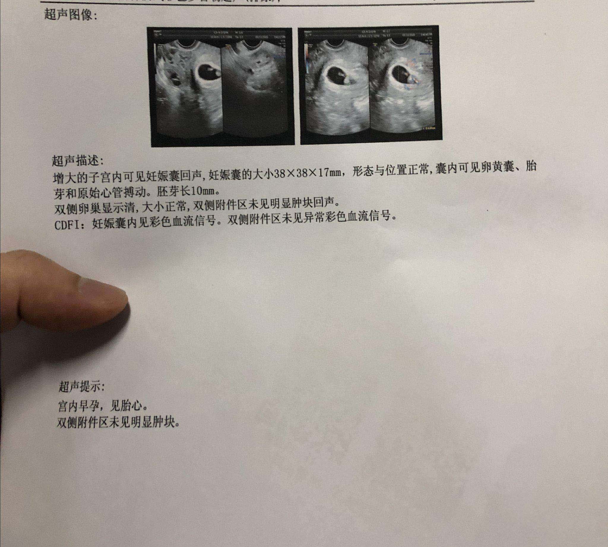 很多宝妈都说孕囊形状能看男女,这种方法准确度高吗? - 柚喜问答